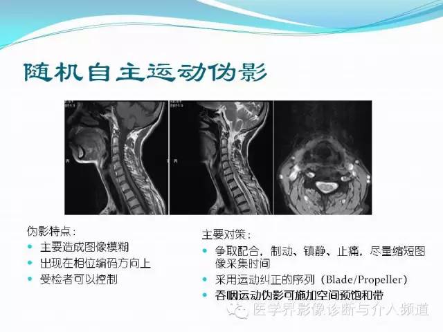【PPT】磁共振常见伪影及对策
