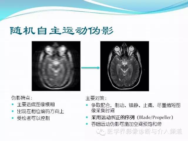 【PPT】磁共振常见伪影及对策
