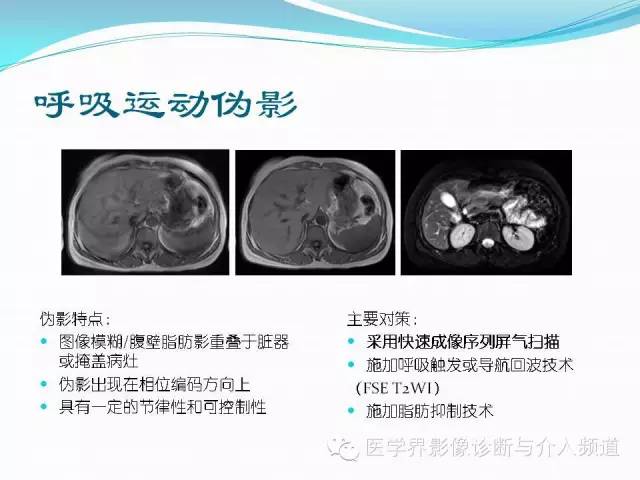 【PPT】磁共振常见伪影及对策