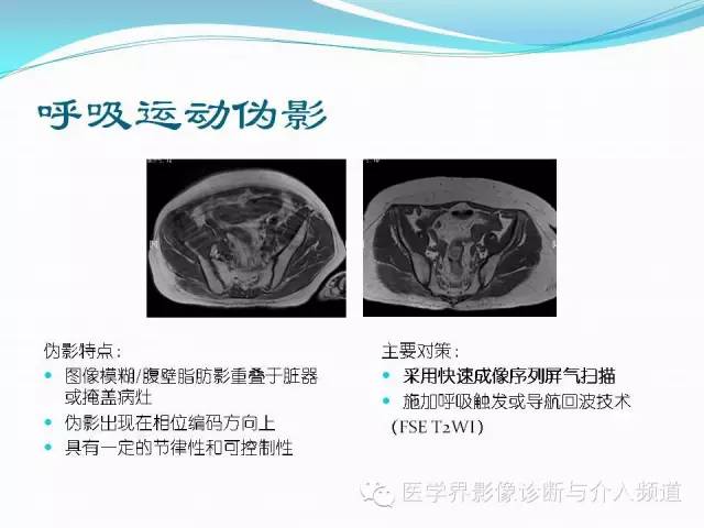 【PPT】磁共振常见伪影及对策