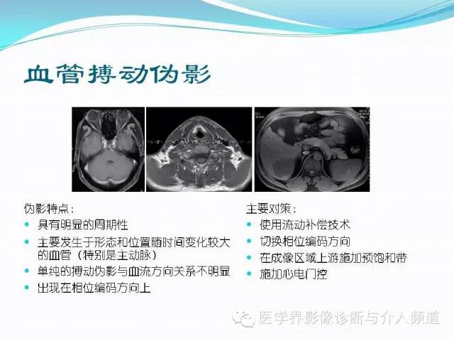 【PPT】磁共振常见伪影及对策