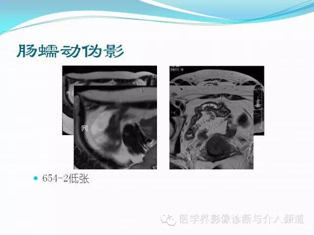 【PPT】磁共振常见伪影及对策
