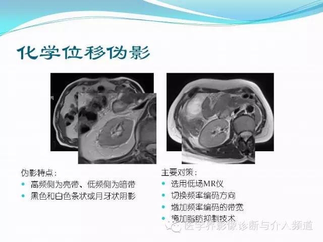 【PPT】磁共振常见伪影及对策