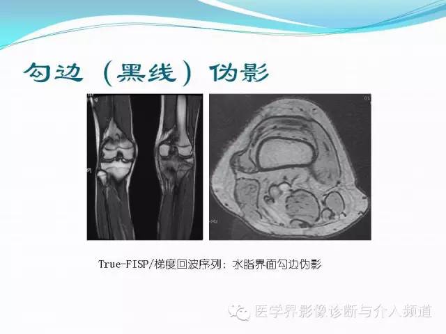 【PPT】磁共振常见伪影及对策