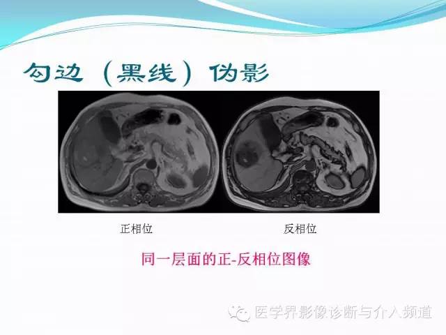 【PPT】磁共振常见伪影及对策