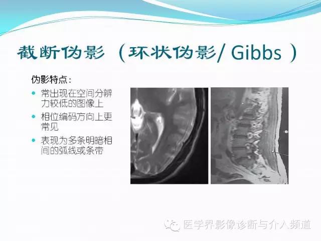 【PPT】磁共振常见伪影及对策