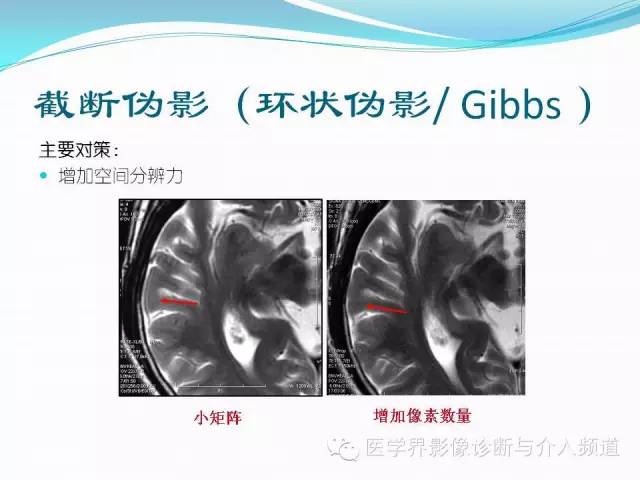 【PPT】磁共振常见伪影及对策