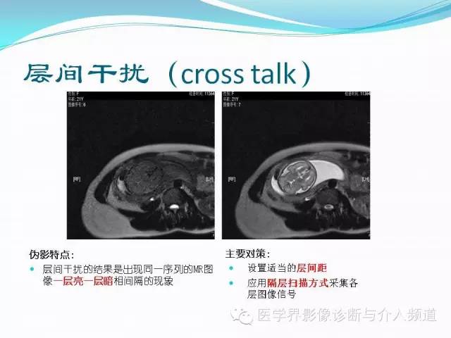【PPT】磁共振常见伪影及对策