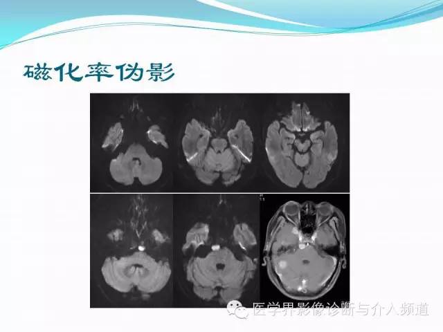 【PPT】磁共振常见伪影及对策