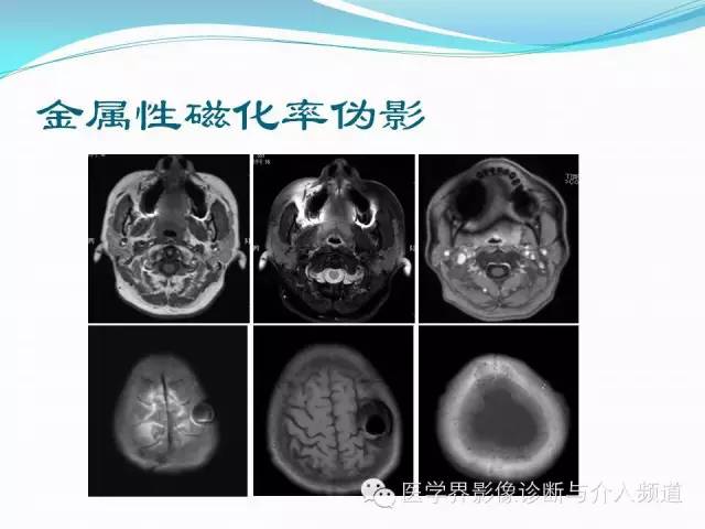 【PPT】磁共振常见伪影及对策