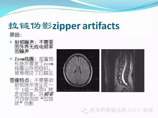 【PPT】磁共振常见伪影及对策