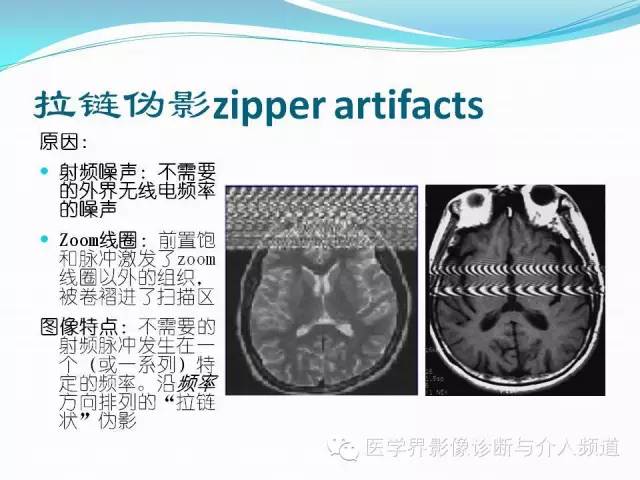【PPT】磁共振常见伪影及对策