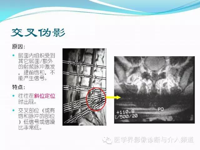 【PPT】磁共振常见伪影及对策