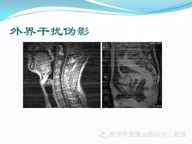【PPT】磁共振常见伪影及对策