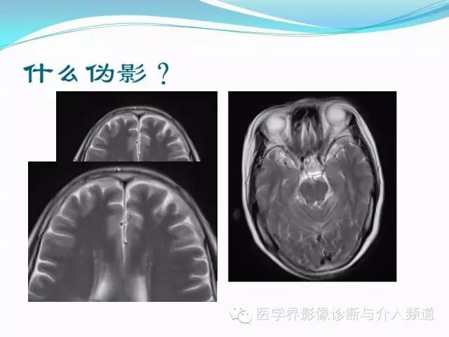 【PPT】磁共振常见伪影及对策