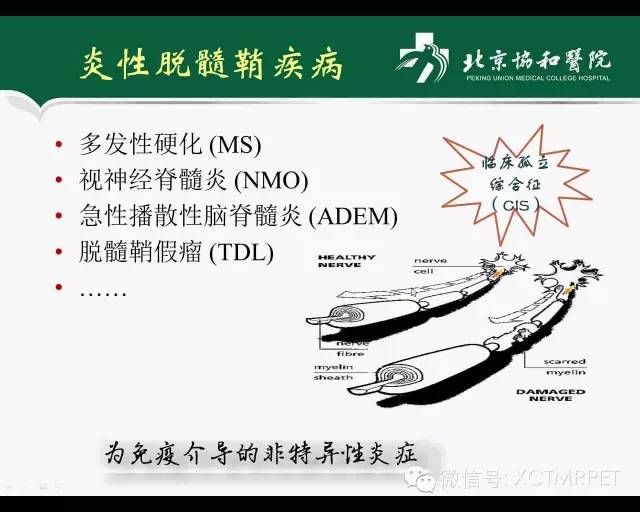 【PPT】炎性脱髓鞘疾病的MR诊断