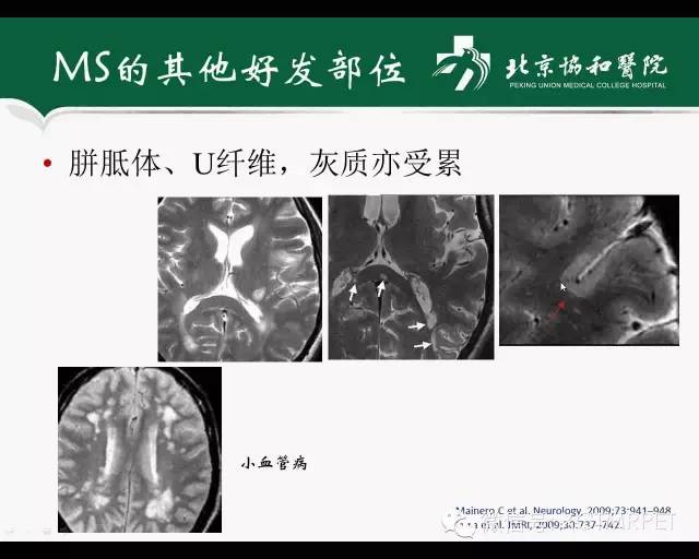 【PPT】炎性脱髓鞘疾病的MR诊断