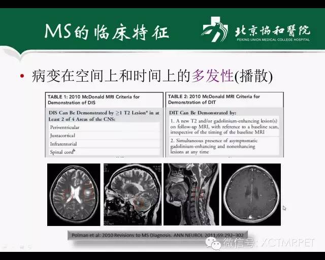 【PPT】炎性脱髓鞘疾病的MR诊断