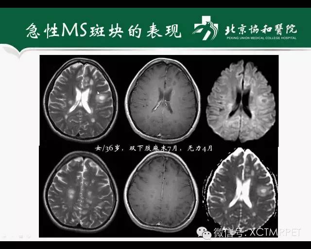 【PPT】炎性脱髓鞘疾病的MR诊断