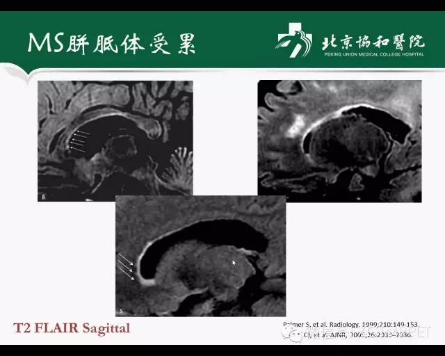 【PPT】炎性脱髓鞘疾病的MR诊断