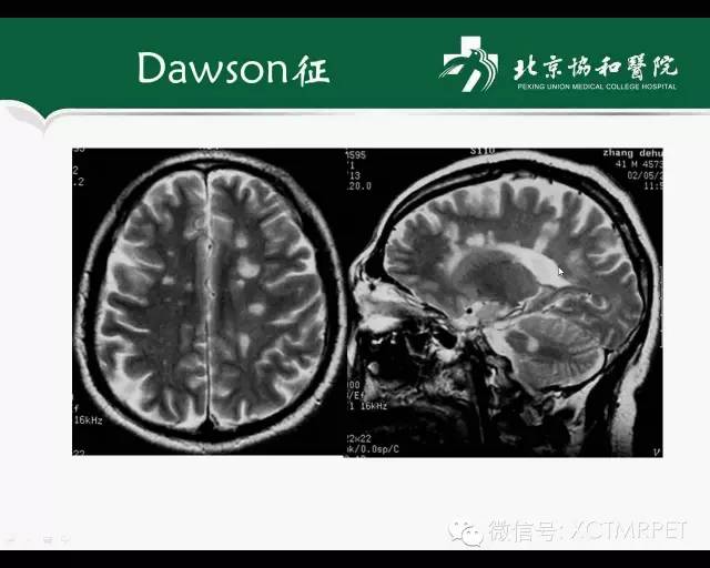【PPT】炎性脱髓鞘疾病的MR诊断