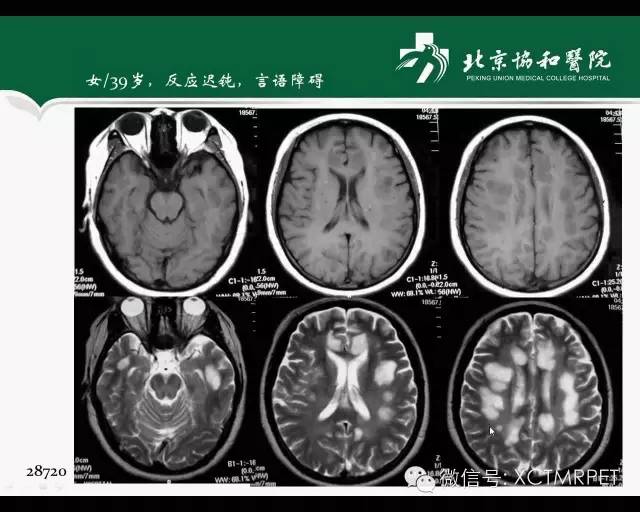 【PPT】炎性脱髓鞘疾病的MR诊断