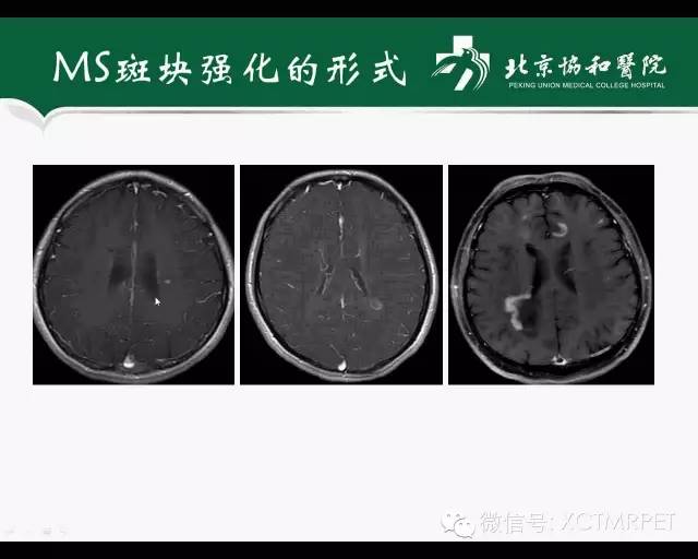 【PPT】炎性脱髓鞘疾病的MR诊断