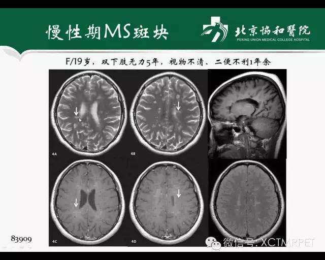 【PPT】炎性脱髓鞘疾病的MR诊断
