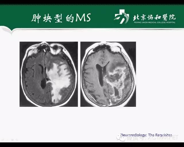 【PPT】炎性脱髓鞘疾病的MR诊断