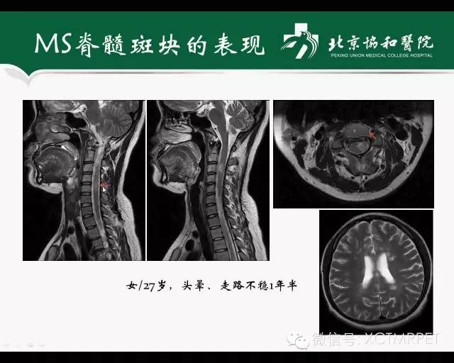 【PPT】炎性脱髓鞘疾病的MR诊断