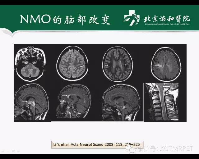 【PPT】炎性脱髓鞘疾病的MR诊断
