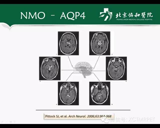 【PPT】炎性脱髓鞘疾病的MR诊断