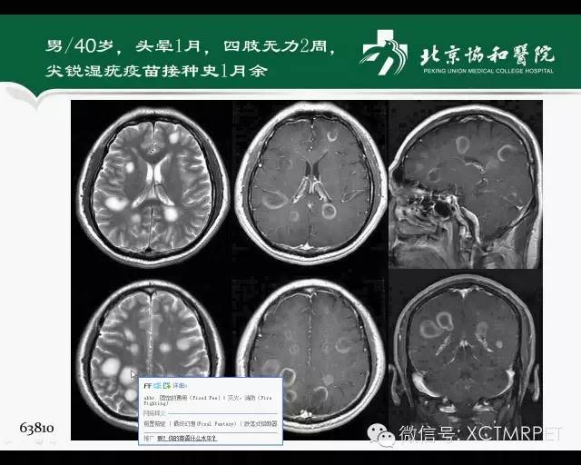 【PPT】炎性脱髓鞘疾病的MR诊断