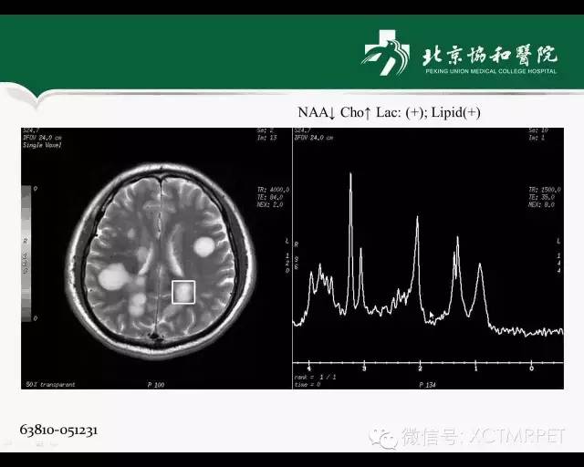 【PPT】炎性脱髓鞘疾病的MR诊断