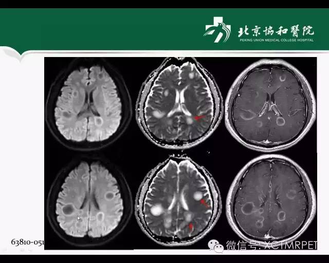 【PPT】炎性脱髓鞘疾病的MR诊断