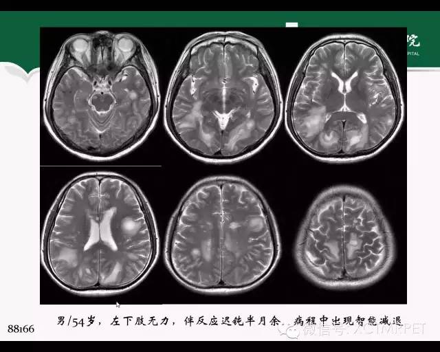 【PPT】炎性脱髓鞘疾病的MR诊断
