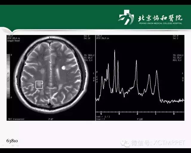 【PPT】炎性脱髓鞘疾病的MR诊断