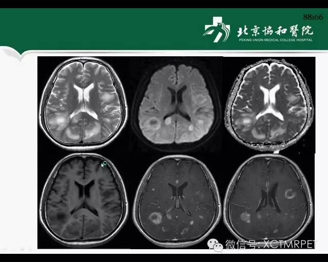 【PPT】炎性脱髓鞘疾病的MR诊断