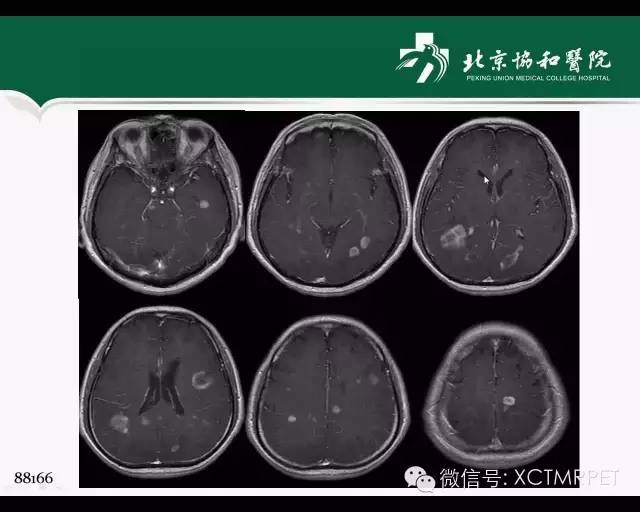 【PPT】炎性脱髓鞘疾病的MR诊断