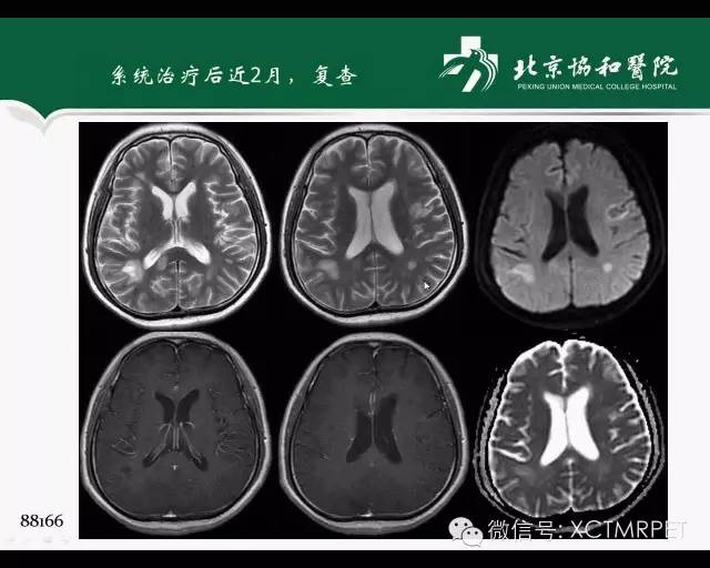 【PPT】炎性脱髓鞘疾病的MR诊断