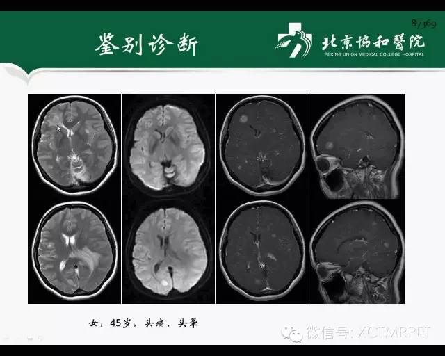 【PPT】炎性脱髓鞘疾病的MR诊断