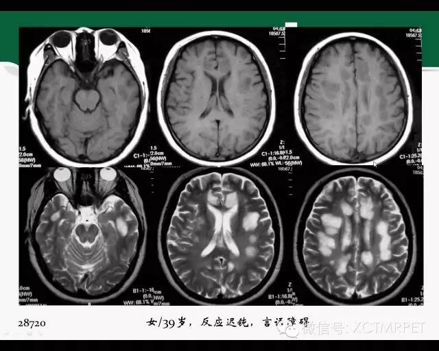 【PPT】炎性脱髓鞘疾病的MR诊断