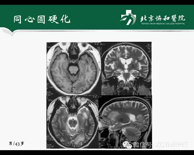 【PPT】炎性脱髓鞘疾病的MR诊断