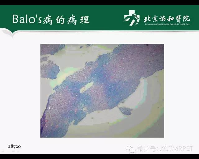 【PPT】炎性脱髓鞘疾病的MR诊断