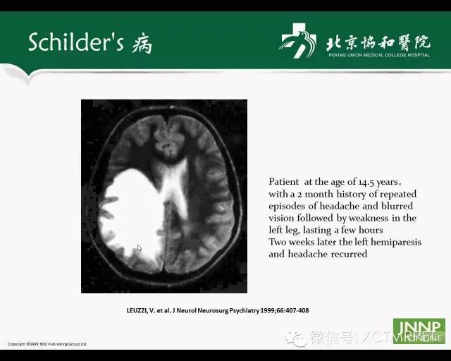 【PPT】炎性脱髓鞘疾病的MR诊断