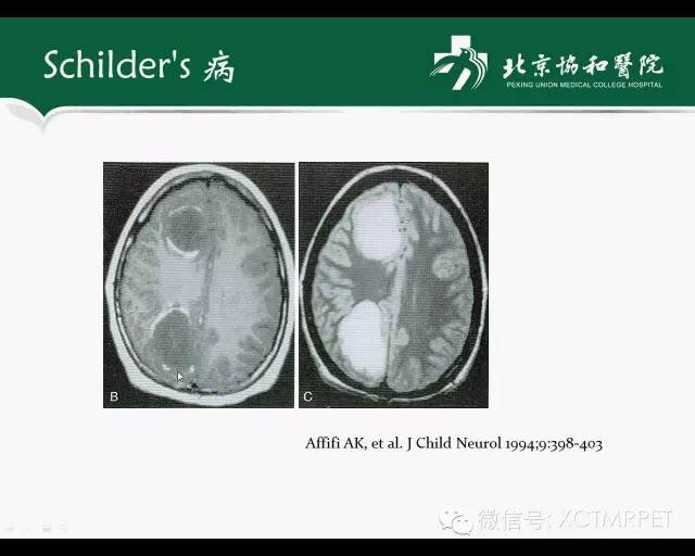 【PPT】炎性脱髓鞘疾病的MR诊断