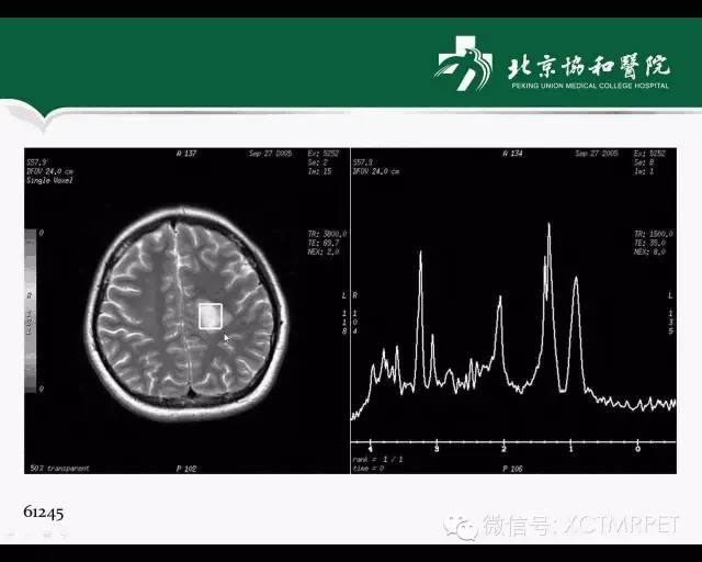 【PPT】炎性脱髓鞘疾病的MR诊断
