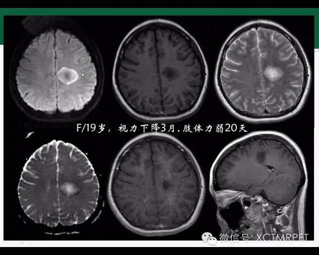 【PPT】炎性脱髓鞘疾病的MR诊断
