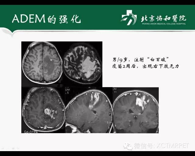 【PPT】炎性脱髓鞘疾病的MR诊断
