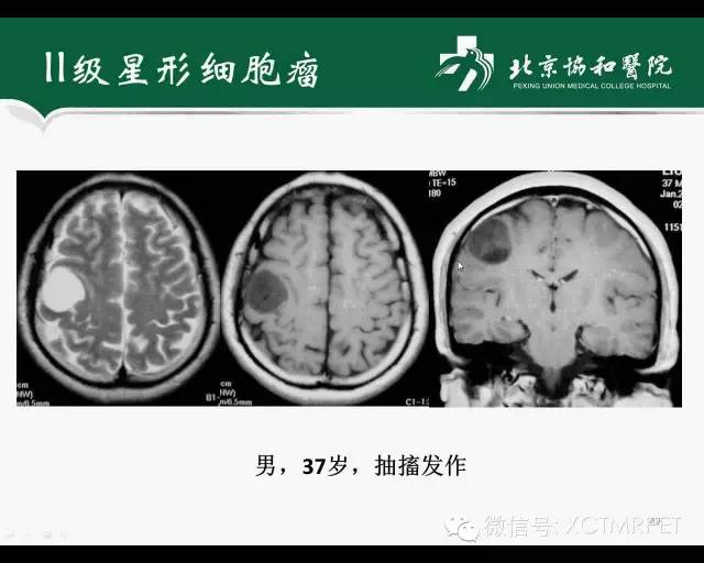 【PPT】炎性脱髓鞘疾病的MR诊断